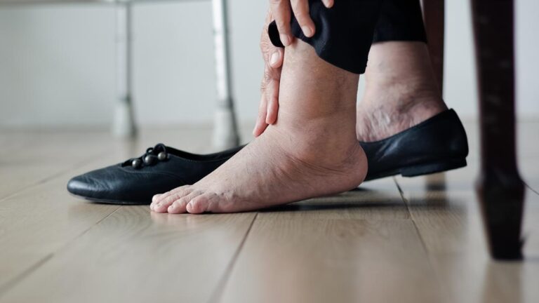 Manejo del edema en la tercera edad